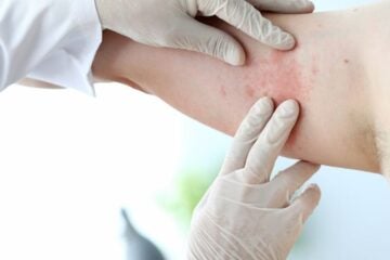 Male doctor in white latex gloves examines patient with skin disease against office background. Photography by Getty Images.